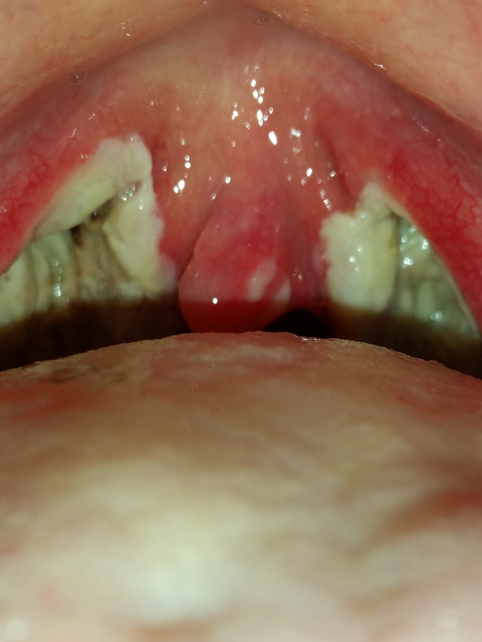 Mandel OP: Meine Tonsillektomie und die Nachwirkungen in 13 Tagen - YouTube